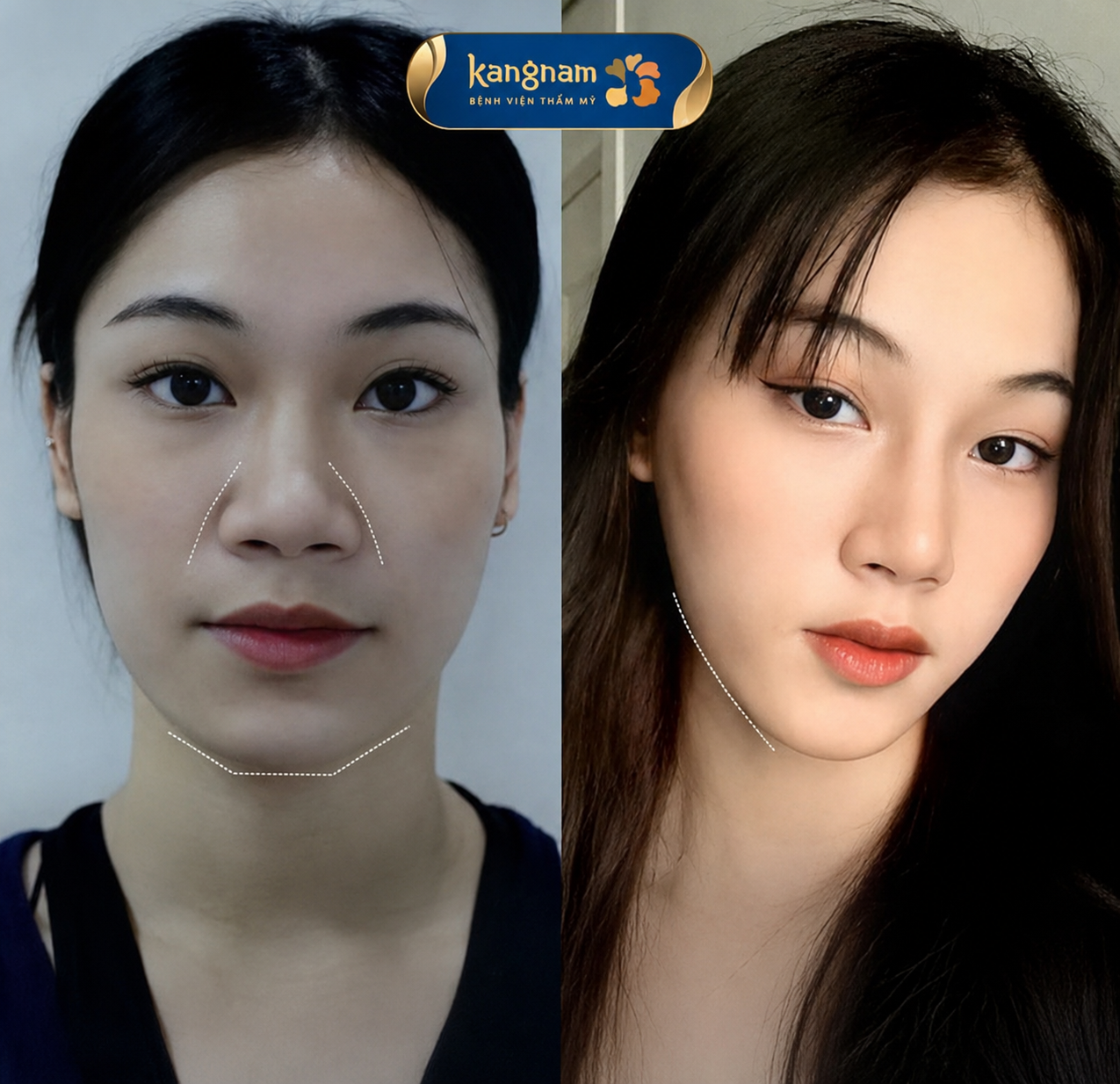 Customer results after chin filler treatment at Kangnam.