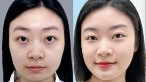 Chin Reduction (Chin Contouring) for a V-Line Jaw