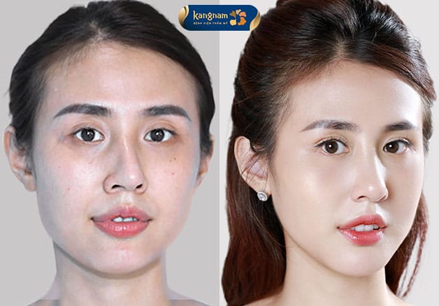 During rhinoplasty, the doctor may modify the nasal bones, cartilage, or other nasal structures.