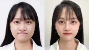 Cleft Palate Surgery Before & After Results