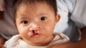 Cleft Palate Surgery: Restoring Function and Appearance