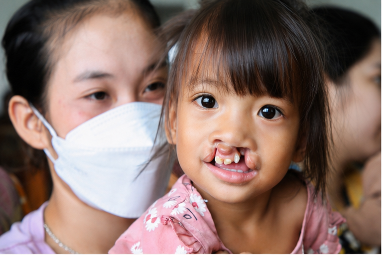 There are many causes of cleft palate in children