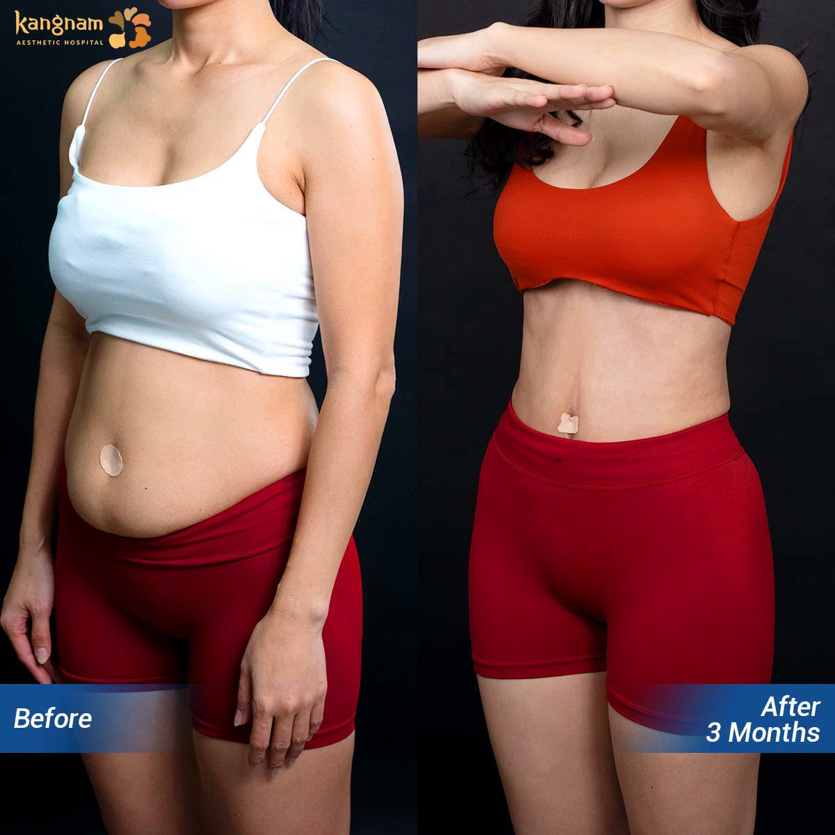 Client achieves a slim waistline after liposuction.