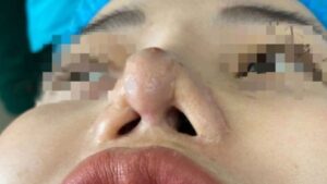 7 Rib Cartilage Rhinoplasty Complications and How to Prevent Them