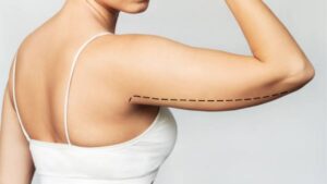 How Long to Wear Compression After Arm Liposuction?