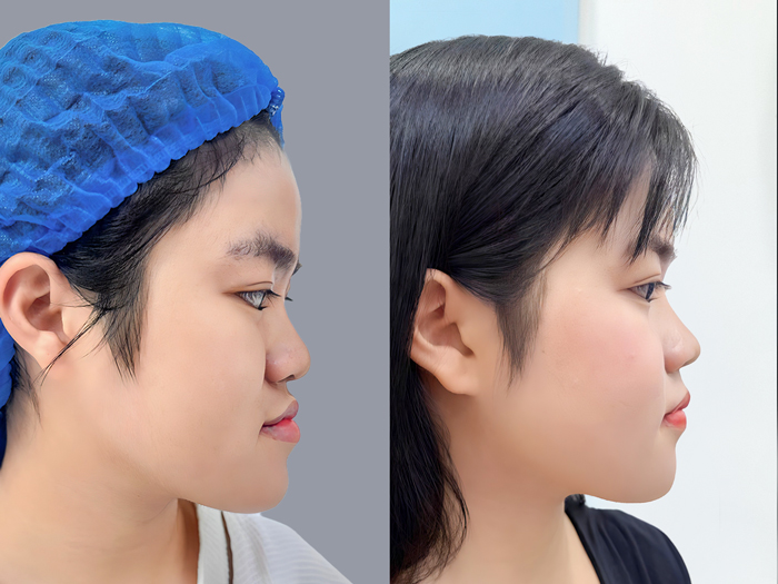 After correcting the plow-shaped face, facial features become more balanced