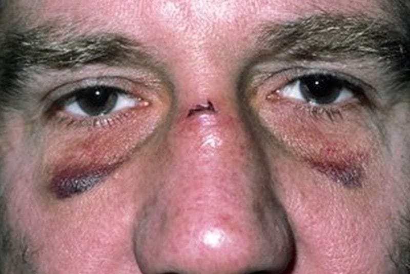 Severe pain following a nasal bone fracture