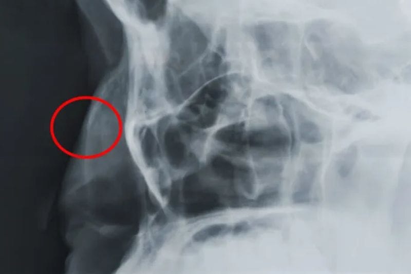 Nasal X-ray detecting a nasal bone fracture