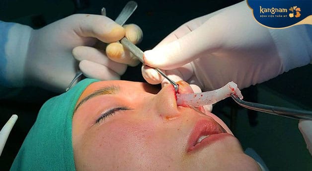 An infected nasal implant may need to be removed. 