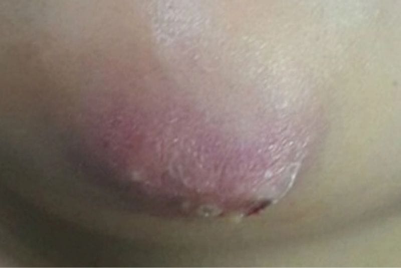 Cơ thể phản ứng với chất filler, gây sưng đỏ, đau nhức và chảy dịch