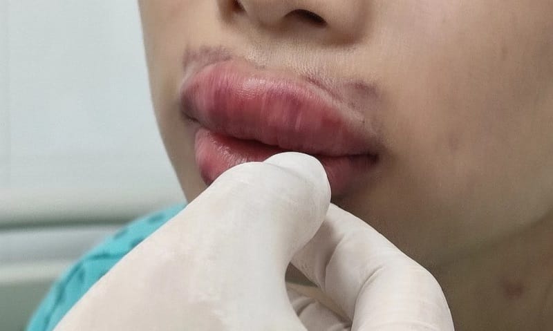 Abnormal discharge from the lips may indicate infection or tissue injury.