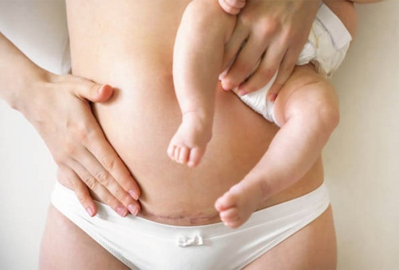 Abdominal liposuction should not be performed too early after a C-section