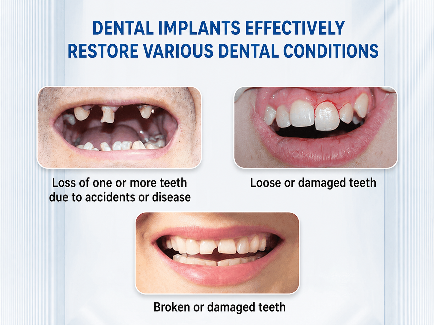 Cases recommended for dental implants