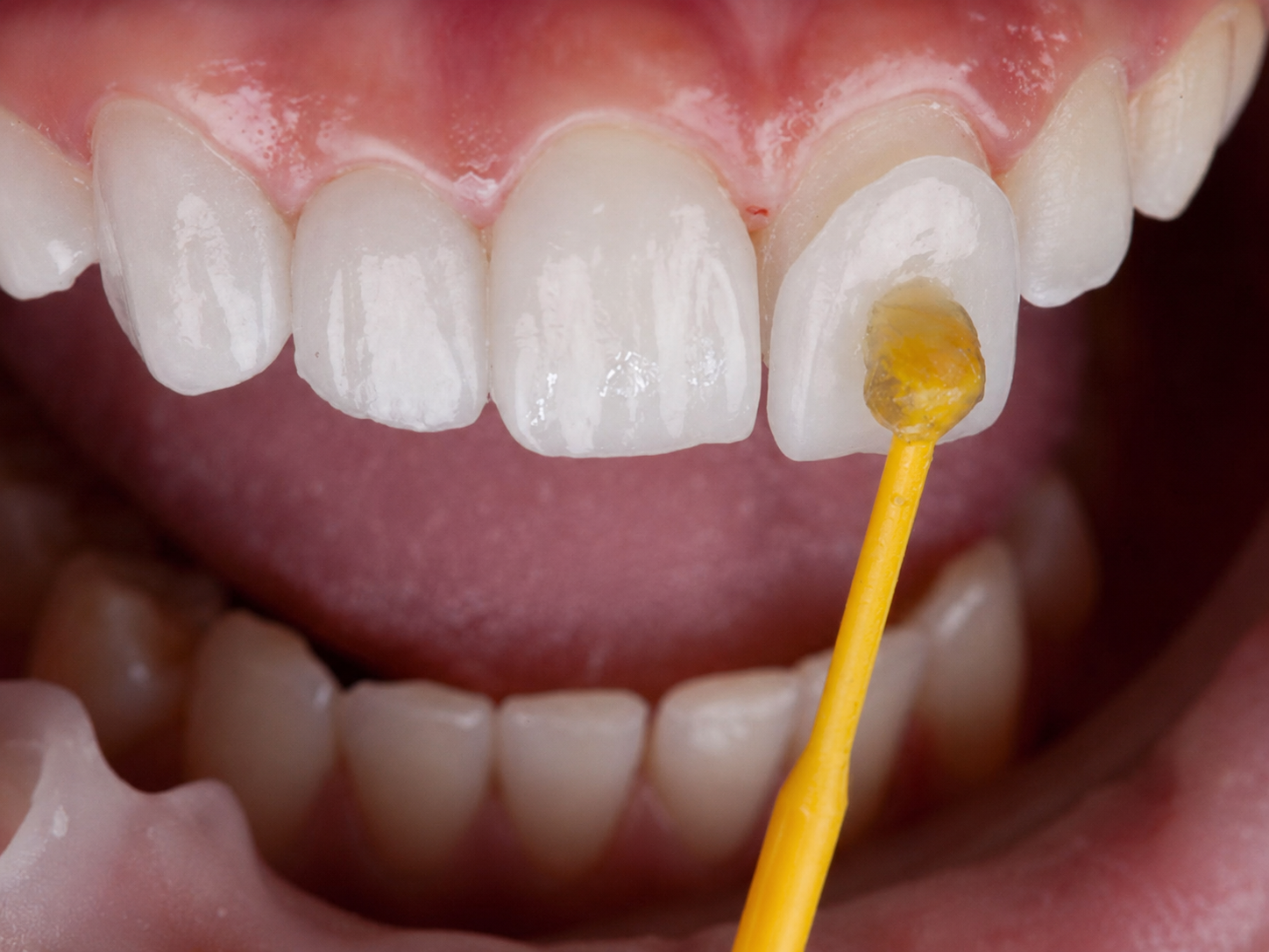 Porcelain veneers utilize ceramic shells with a thickness of only 0.3 to 0.5 mm