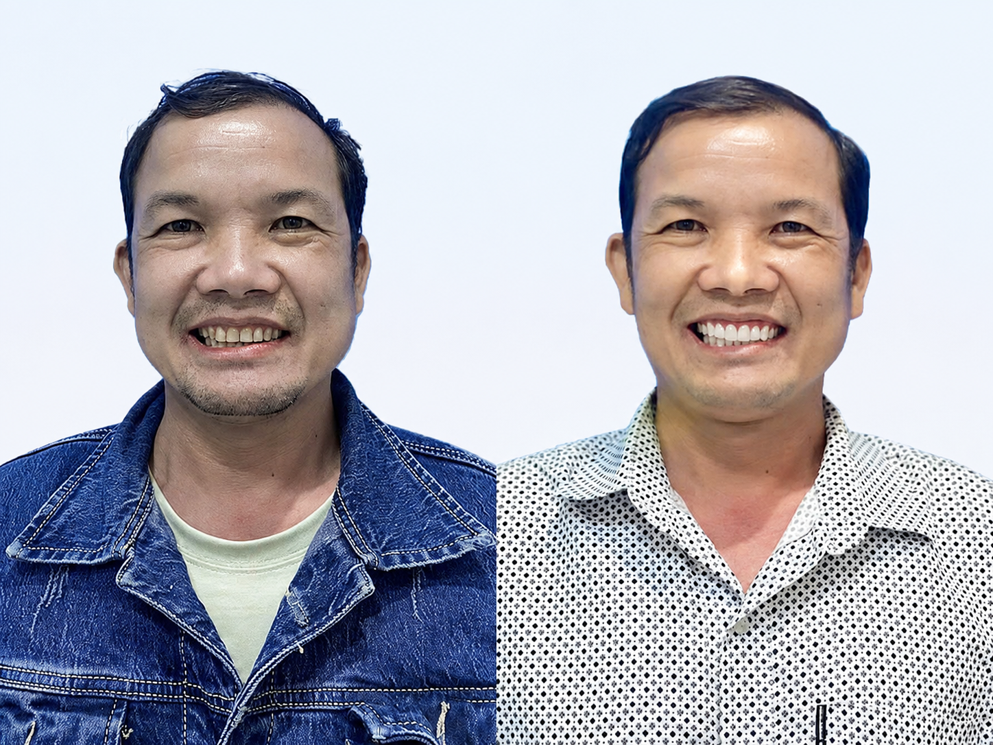 The client enjoys a brighter smile after undergoing porcelain veneer treatment at Kangnam. 