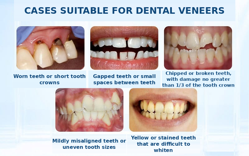 Cases experiencing worn tooth necks, gaps, or chipped teeth should undergo porcelain veneer bonding