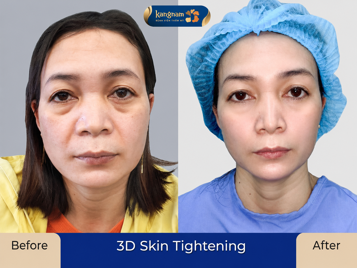 Patients may gradually resume normal activities and eating as their recovery progresses.