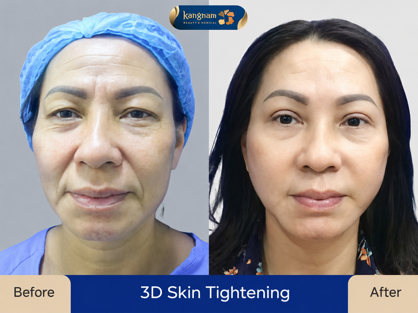 Facelift surgery may create a visibly younger appearance, but the degree of rejuvenation varies between patients.