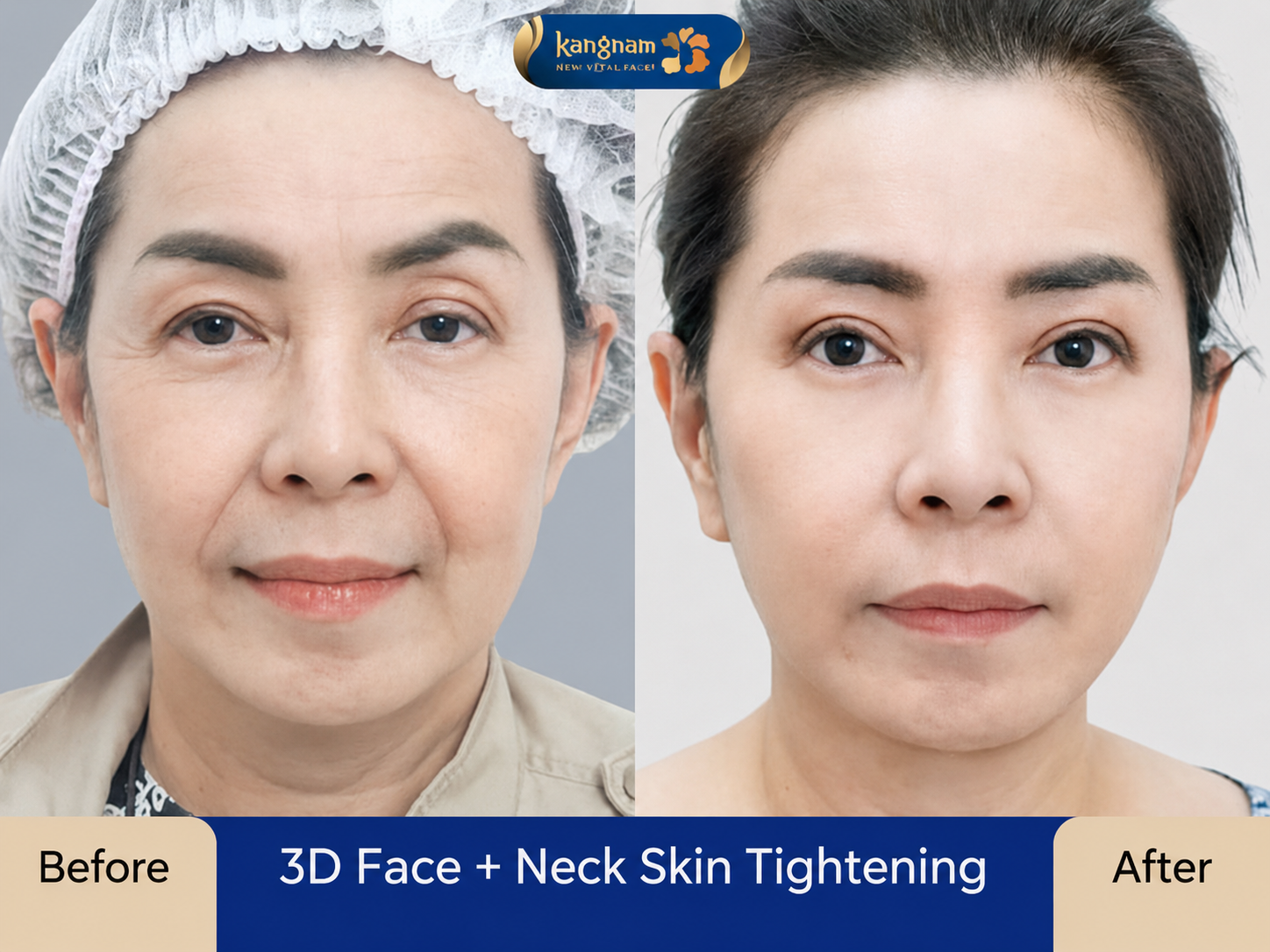 The cost of facelift surgery depends on several clinical and procedural factors.