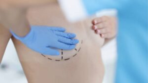 Does Breast Augmentation Reduce Your Lifespan?