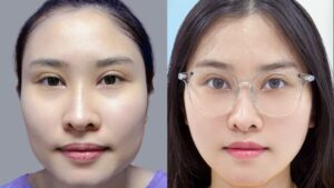 Does Chin Reduction Have Any Side Effects?