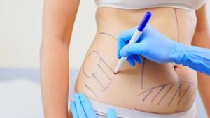 Does Liposuction Hurt? 4 Ways to Ease the Pain