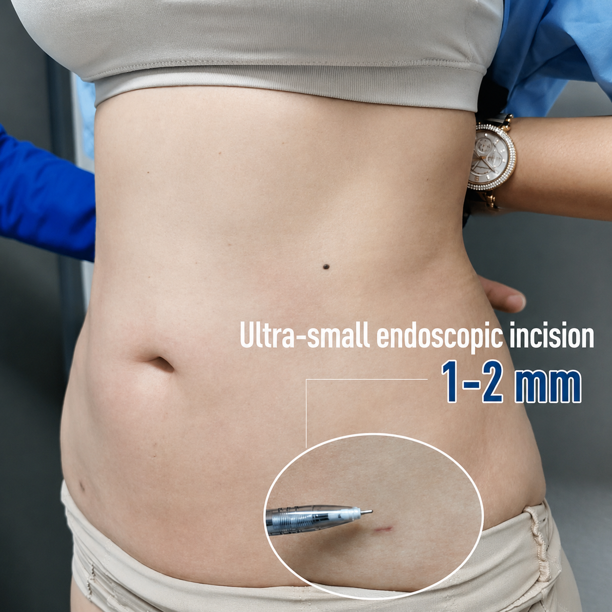 Liposuction scars are generally small and may gradually fade over time.