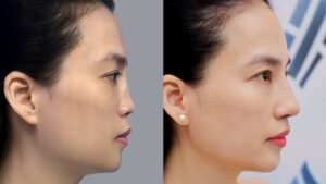 Does Rib Cartilage Shrink After Rhinoplasty?