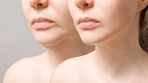 How Much Does Double Chin Liposuction Cost?