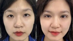 Non-Incisional Double Eyelid (Eyelid Tucking): A No-Cut Solution