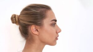 Ear Cartilage Rhinoplasty: A Soft, Natural Nasal Tip