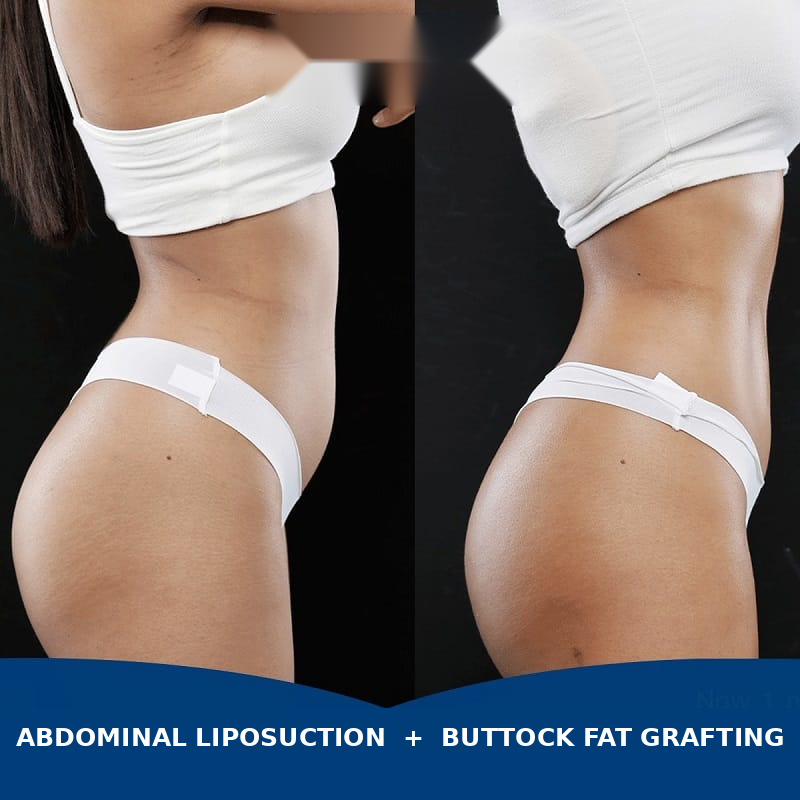 Abdominal liposuction with buttock fat transfer may improve body proportions when performed using an appropriate medical technique.