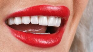 Emax Porcelain Crowns & Veneers: Premium Aesthetics