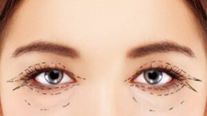 Excess Eyelid Skin Removal: What It Is and Why It Helps
