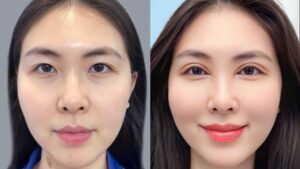 Epicanthoplasty (Eye Corner Surgery) for Bigger, Rounder Eyes
