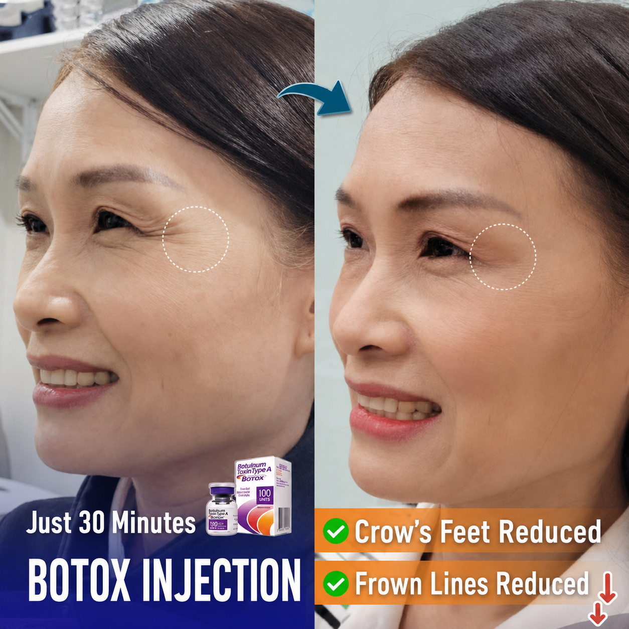 Eye-wrinkle injections should be performed at a reputable medical or aesthetic facility.