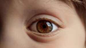 Can People with Bulging Eyes Get Eyelid Surgery?