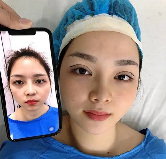 Eyelid suturing helps improve single eyelids and hidden double eyelids
