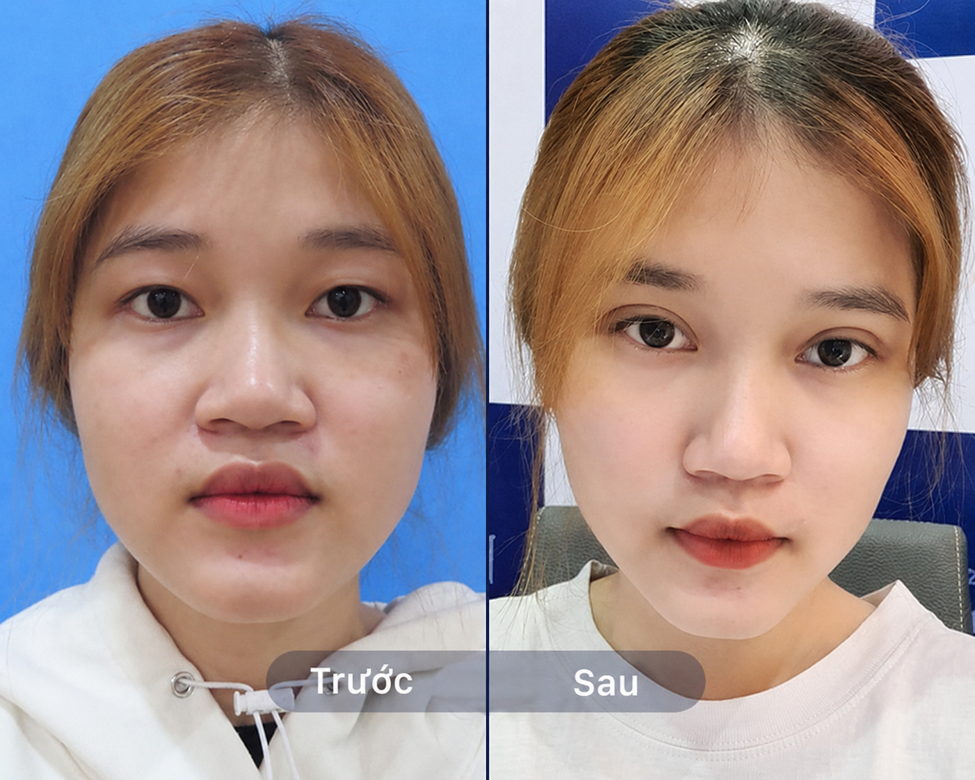 Eyelid suturing is a 2-in-1 beauty technique that recreates eyelid folds while making eyes look larger