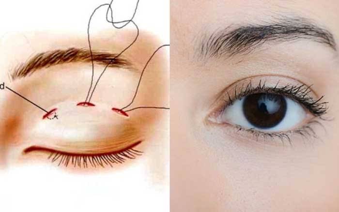 Eyelid creasing helps improve single eyelids and hidden double eyelids