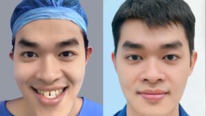 Facial Asymmetry Surgery: Correcting an Uneven Face