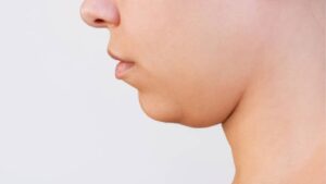 Facial Liposuction: A Slimmer, More Defined Face