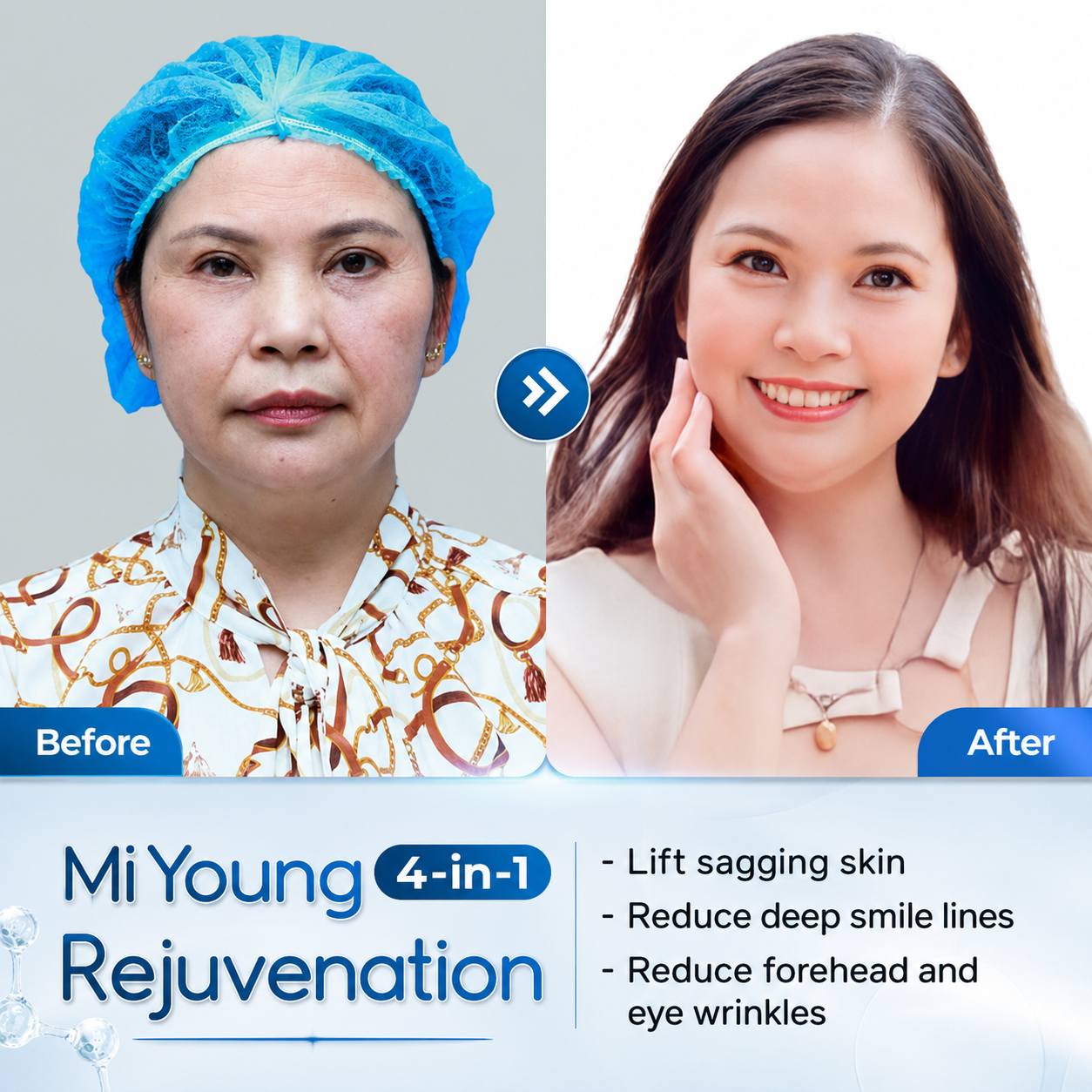 Mi Young skin rejuvenation helps you look 10 years younger