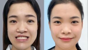 Corrective Jaw Surgery for a Proper Bite (Malocclusion)