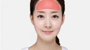 Forehead Augmentation: A Smooth, Balanced Forehead