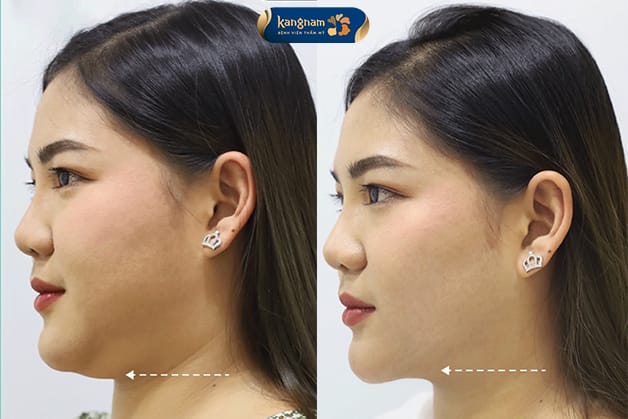 Double-chin fat may be reduced after one appropriately planned procedure.