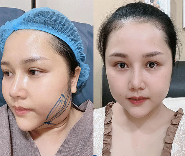 Chin liposuction removes localised fat accumulated beneath the chin.