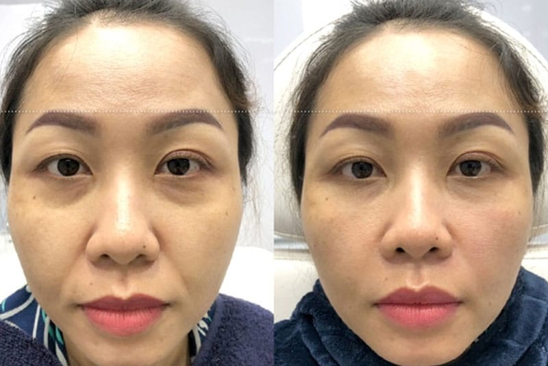 Lifestyle and daily habits can influence how long under-eye treatment results last.