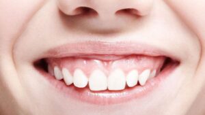 Gummy Smile Correction: Showing Less Gum When You Smile