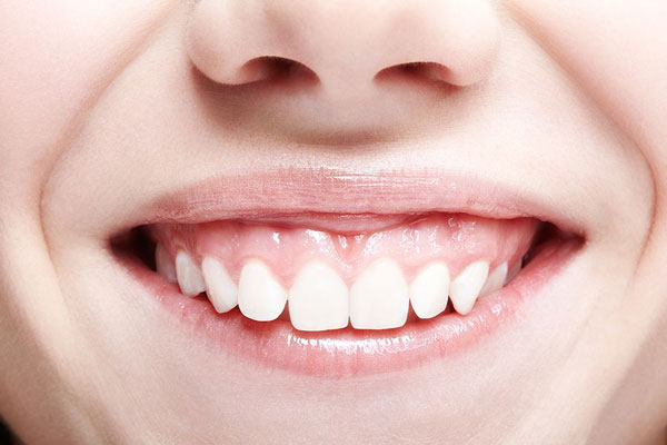 A gummy smile is not a pathology, but it significantly impacts overall aesthetics